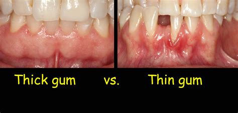 gingival tissue biotype